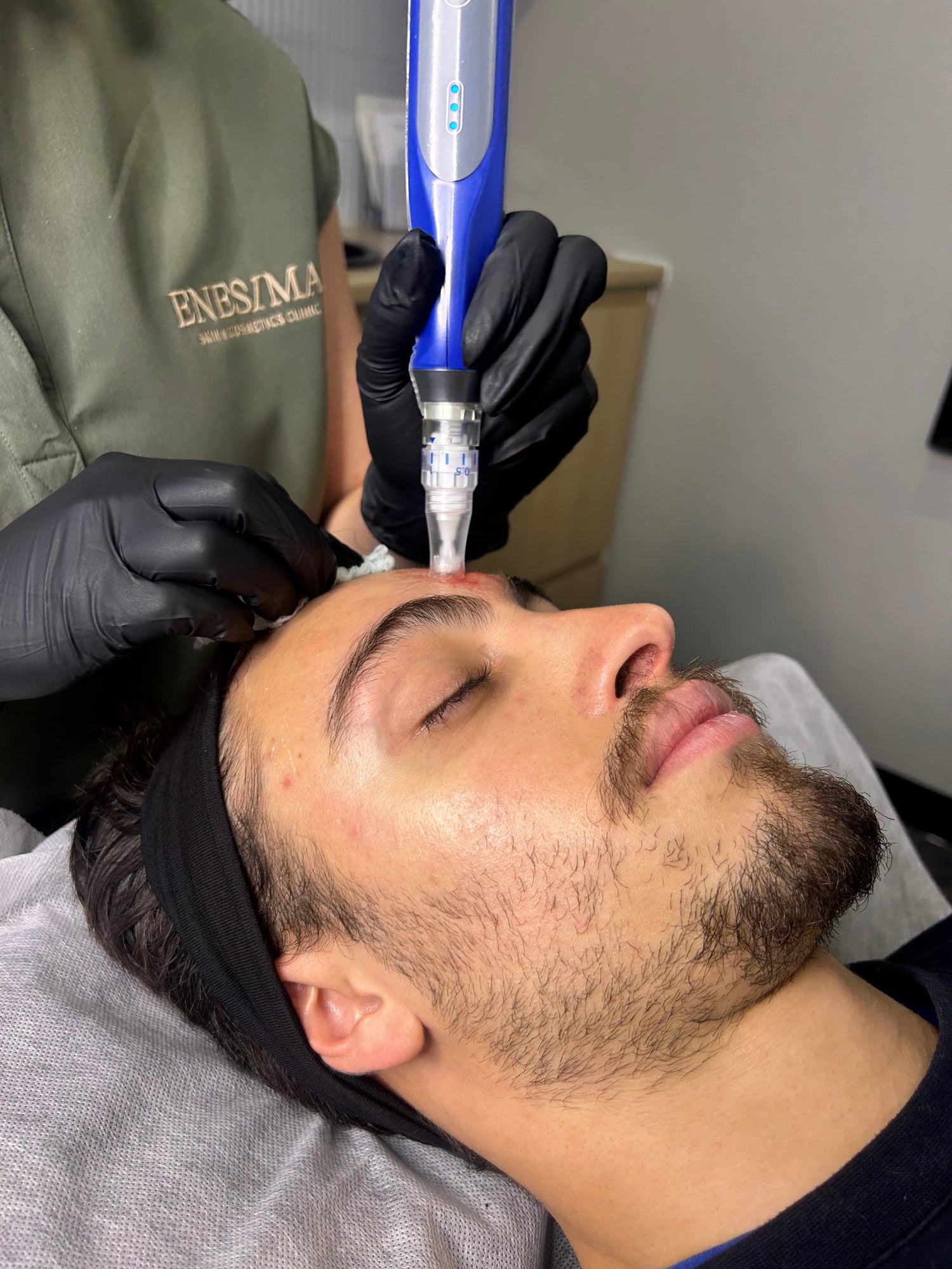 MICRONEEDLING SKINPEN